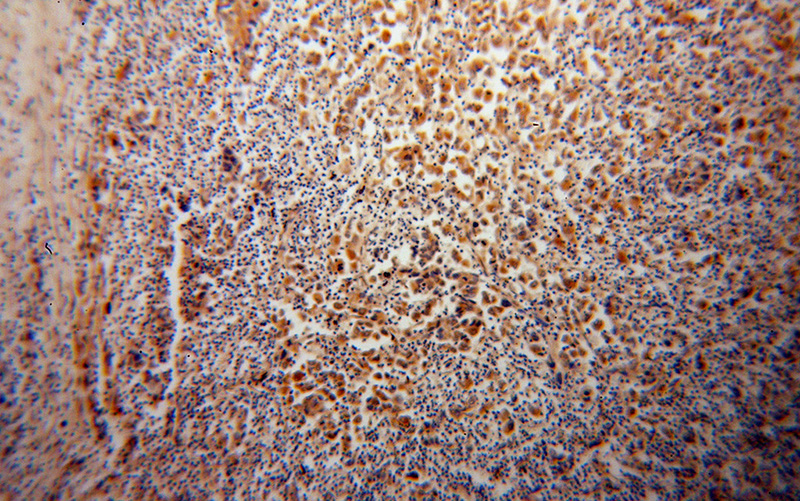 Immunohistochemical of paraffin-embedded human pancreas cancer using Catalog No:115812(STXBP4 antibody) at dilution of 1:100 (under 10x lens)