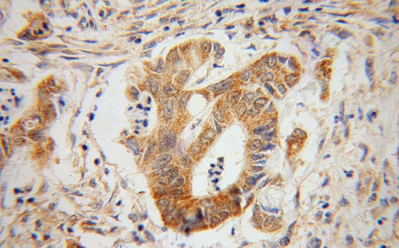 Immunohistochemical of paraffin-embedded human colon cancer using Catalog No:111036(GLRX3 antibody) at dilution of 1:50 (under 40x lens)