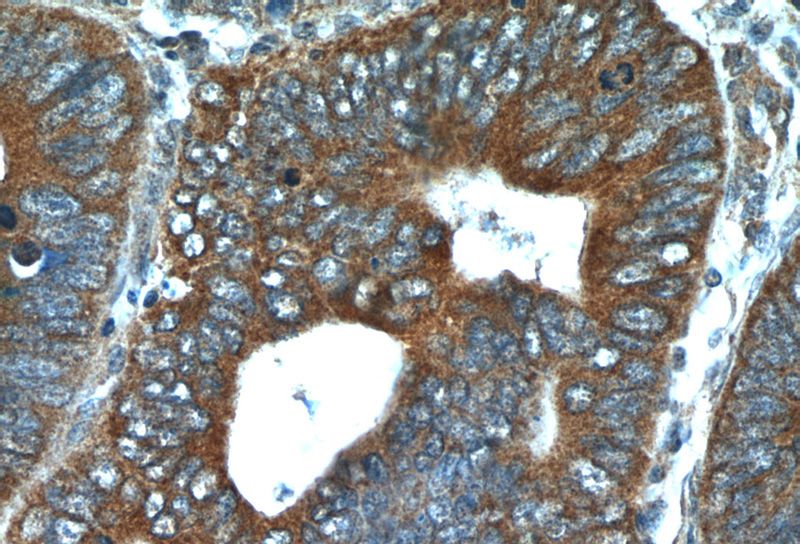 Immunohistochemistry of paraffin-embedded human colon cancer tissue slide using Catalog No:110637(FGFBP1 Antibody) at dilution of 1:50 (under 40x lens)