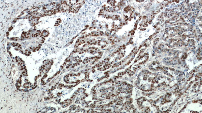Immunohistochemical of paraffin-embedded human ovary tumor using Catalog No:111386(HDGF antibody) at dilution of 1:100 (under 10x lens)