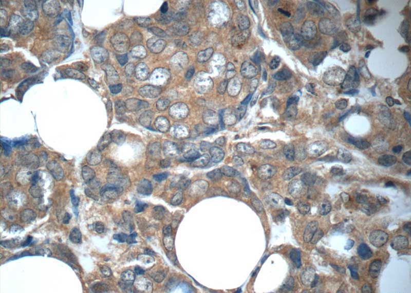 Immunohistochemistry of paraffin-embedded human breast cancer tissue slide using Catalog No:107209(FGFR1 Antibody) at dilution of 1:50 (under 40x lens)