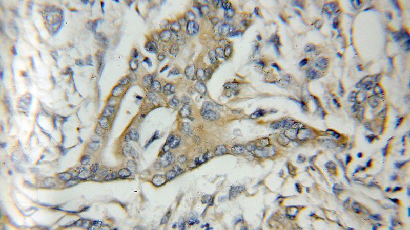 Immunohistochemical of paraffin-embedded human pancreas cancer using Catalog No:111906(SERPINA4 antibody) at dilution of 1:50 (under 10x lens)