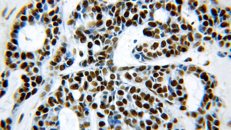 Immunohistochemical of paraffin-embedded human cervical cancer using Catalog No:111751(NF90,ILF3 antibody) at dilution of 1:100 (under 40x lens)