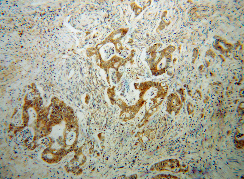 Immunohistochemical of paraffin-embedded human colon cancer using Catalog No:111036(GLRX3 antibody) at dilution of 1:50 (under 10x lens)