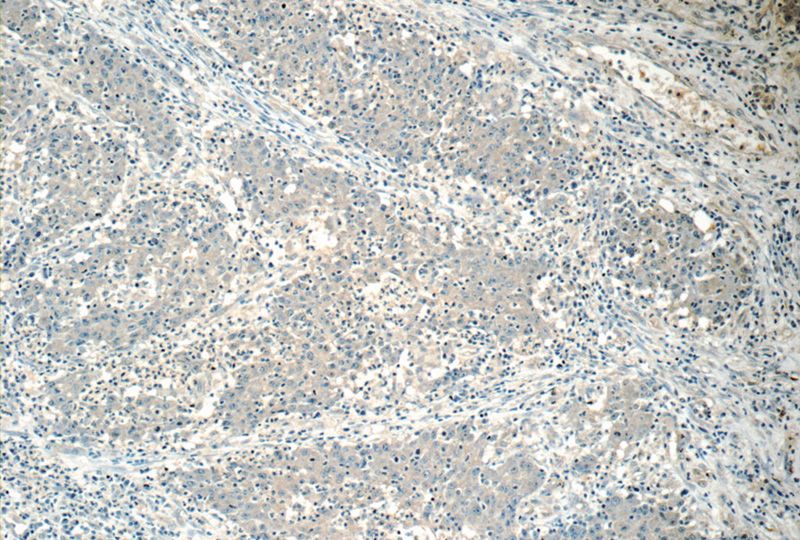 Immunohistochemistry of paraffin-embedded human colon cancer tissue slide using Catalog No:111541(HSCB Antibody) at dilution of 1:50 (under 10x lens)