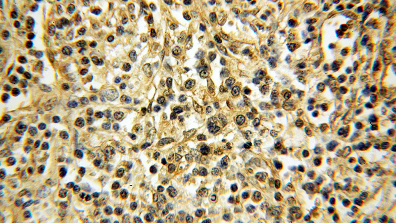 Immunohistochemical of paraffin-embedded human lymphoma using Catalog No:116505(TXK antibody) at dilution of 1:100 (under 40x lens)