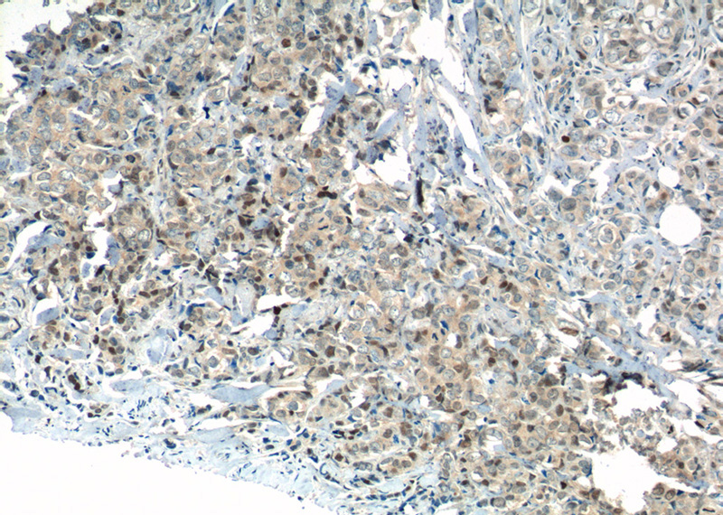 Immunohistochemistry of paraffin-embedded human breast cancer tissue slide using Catalog No:112041(KI67 Antibody) at dilution of 1:400 (under 10x lens). heat mediated antigen retrieved with Sodium Citrate buffer (pH6).