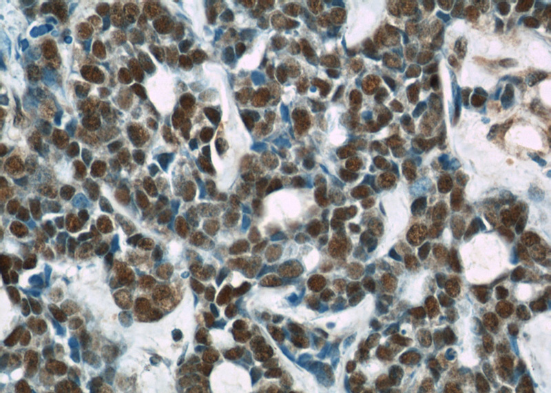 Immunohistochemical of paraffin-embedded human cervical cancer using Catalog No:107497(RBBP4 antibody) at dilution of 1:200 (under 40x lens)