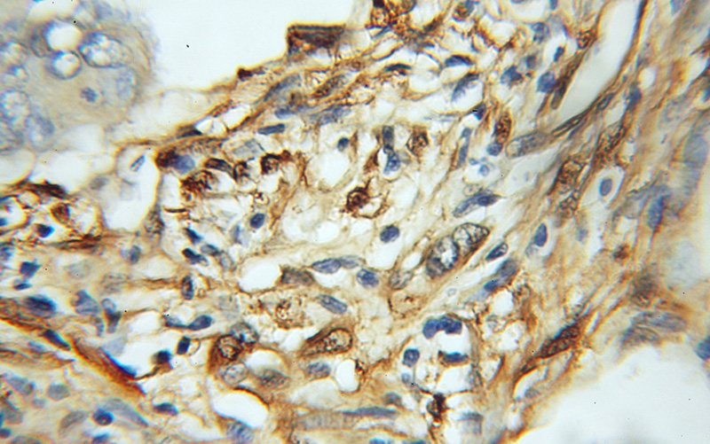Immunohistochemical of paraffin-embedded human colon cancer using Catalog No:110839(GAL1,LGALS1 antibody) at dilution of 1:100 (under 10x lens)