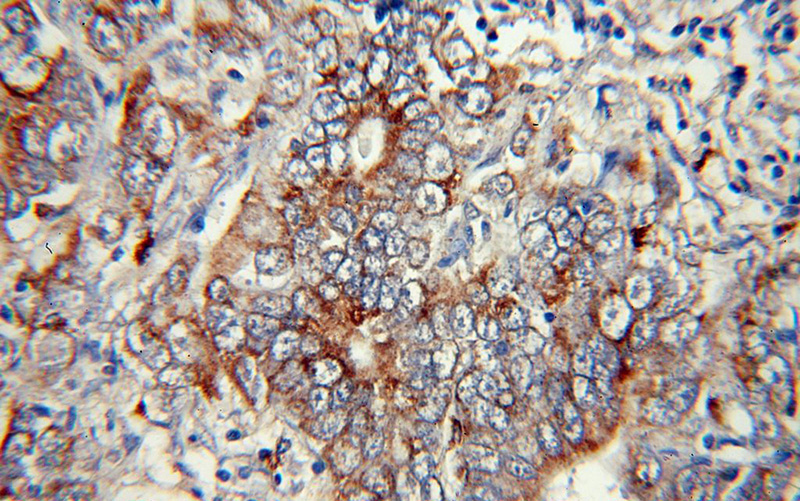 Immunohistochemical of paraffin-embedded human stomach cancer using Catalog No:108838(CAPN9 antibody) at dilution of 1:100 (under 40x lens)
