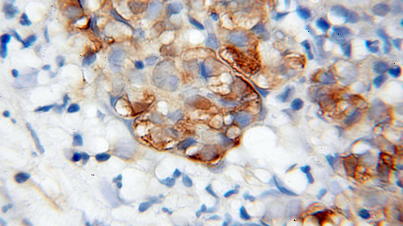 Immunohistochemical of paraffin-embedded human pancreas cancer using Catalog No:116979(WWP2 antibody) at dilution of 1:100 (under 40x lens)