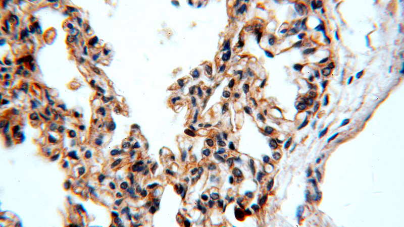 Immunohistochemical of paraffin-embedded human lung using Catalog No:111866(ITGB6-Specific antibody) at dilution of 1:100 (under 40x lens)
