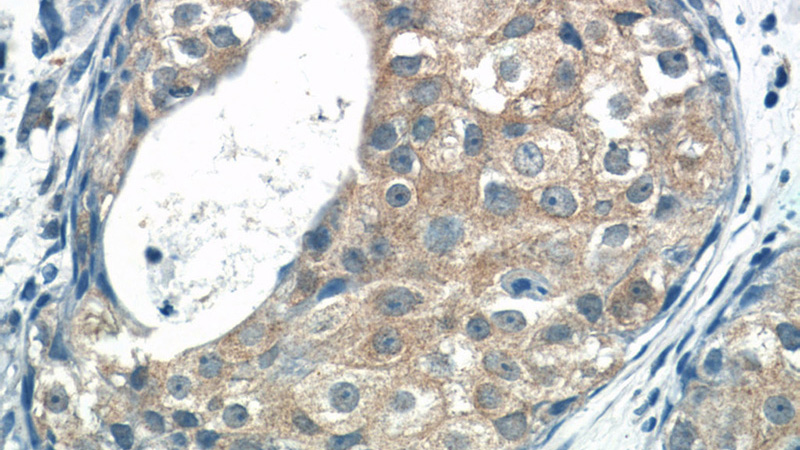 Immunohistochemistry of paraffin-embedded human breast cancer tissue slide using Catalog No:116231(TRAF3IP1 Antibody) at dilution of 1:50 (under 40x lens)