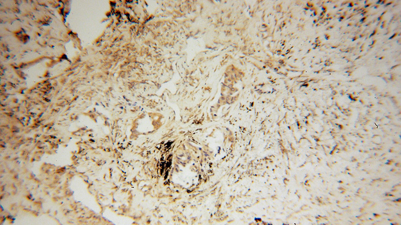 Immunohistochemical of paraffin-embedded human lung cancer using Catalog No:112015(KIF4A antibody) at dilution of 1:50 (under 10x lens)