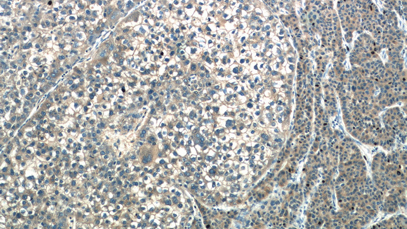 Immunohistochemistry of paraffin-embedded human liver cancer tissue slide using Catalog No:108933(CAP2 Antibody) at dilution of 1:50 (under 10x lens)