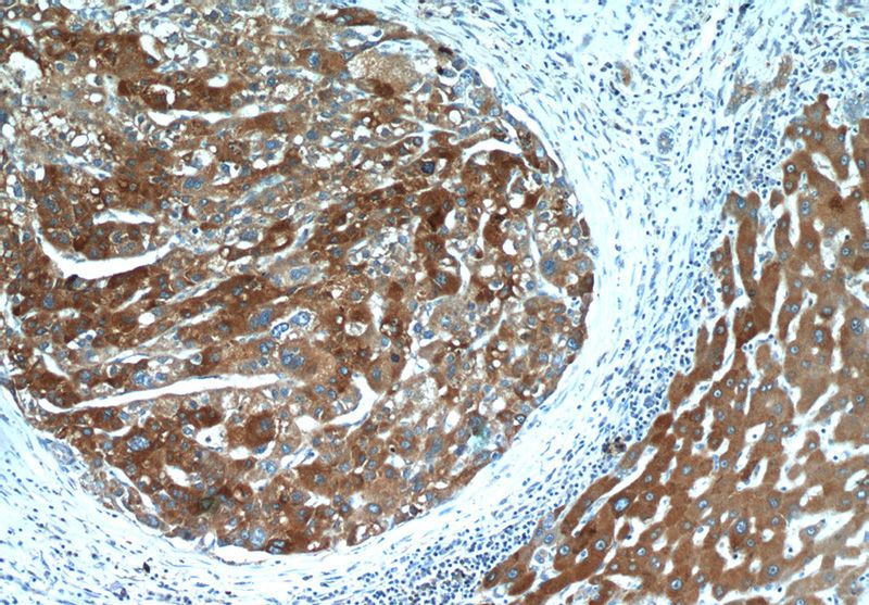 Immunohistochemistry of paraffin-embedded human liver cancer tissue slide using Catalog No:116259(TP53INP1 Antibody) at dilution of 1:50 (under 10x lens)