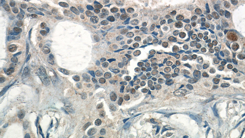 Immunohistochemistry of paraffin-embedded human breast cancer tissue slide using Catalog No:111899(JUN Antibody) at dilution of 1:50 (under 40x lens)