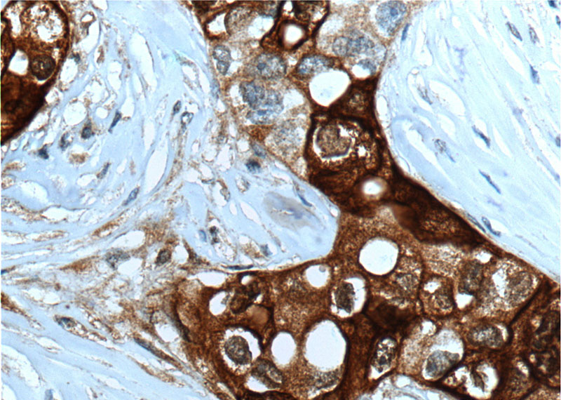 Immunohistochemistry of paraffin-embedded human breast cancer tissue slide using Catalog No:107413(SCGB2A2 Antibody) at dilution of 1:200 (under 40x lens). heat mediated antigen retrieved with Tris-EDTA buffer(pH9).