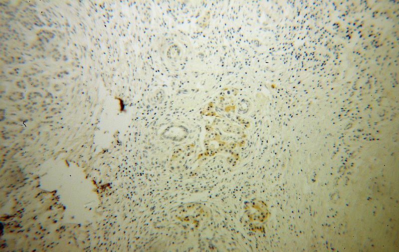 Immunohistochemical of paraffin-embedded human pancreas cancer using Catalog No:114725(RNASET2 antibody) at dilution of 1:100 (under 10x lens)