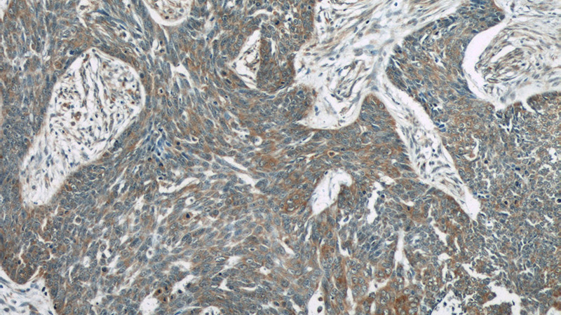 Immunohistochemistry of paraffin-embedded human skin cancer tissue slide using Catalog No:113461(OAS3 Antibody) at dilution of 1:50 (under 10x lens)