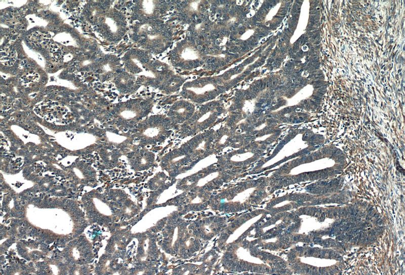 Immunohistochemistry of paraffin-embedded human endometrial cancer tissue slide using Catalog No:113418(ORAI3 Antibody) at dilution of 1:50 (under 10x lens)