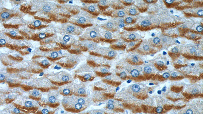 Immunohistochemistry of paraffin-embedded human liver cancer tissue slide using Catalog No:114632(RFTN2 Antibody) at dilution of 1:100 (under 40x lens).