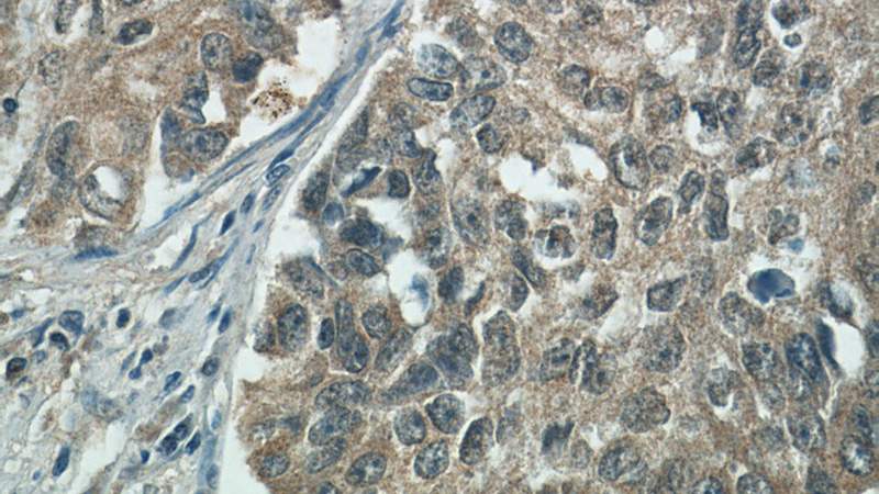 Immunohistochemistry of paraffin-embedded human lung cancer tissue slide using Catalog No:111987(KIAA0907 Antibody) at dilution of 1:50 (under 40x lens)