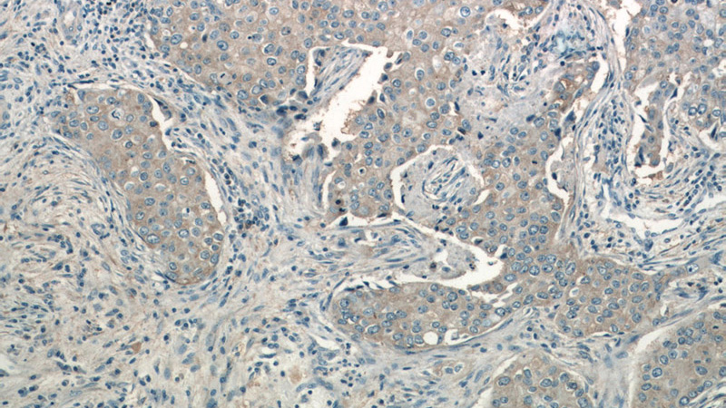 Immunohistochemistry of paraffin-embedded human breast cancer tissue slide using Catalog No:109241(CHKA-Specific Antibody) at dilution of 1:50(under 10x lens)