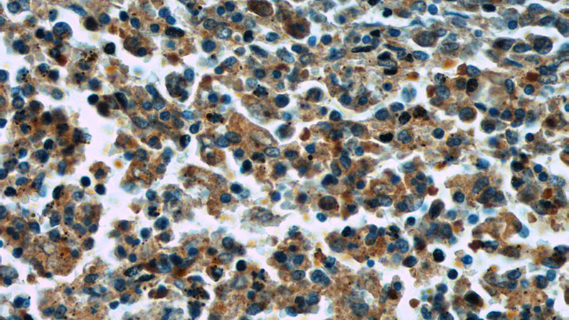 Immunohistochemistry of paraffin-embedded human spleen tissue slide using Catalog No:115255(SKAP55,SKAP1 Antibody) at dilution of 1:50 (under 40x lens)