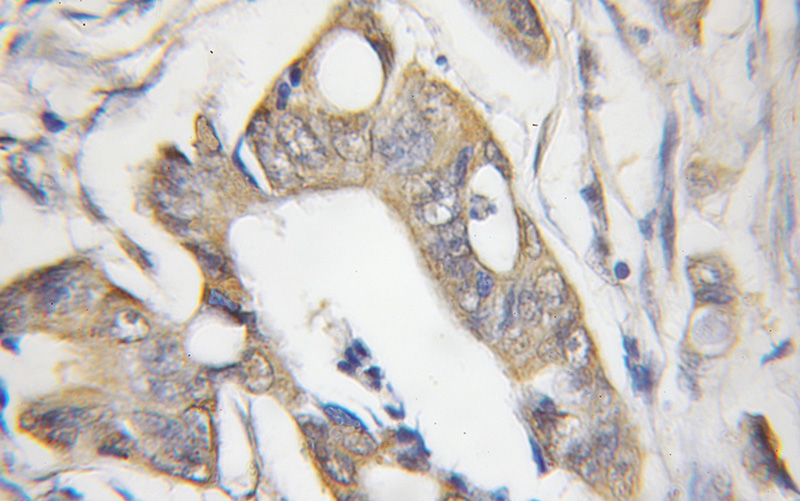 Immunohistochemical of paraffin-embedded human colon cancer using Catalog No:109284(CHRNB1 antibody) at dilution of 1:50 (under 10x lens)