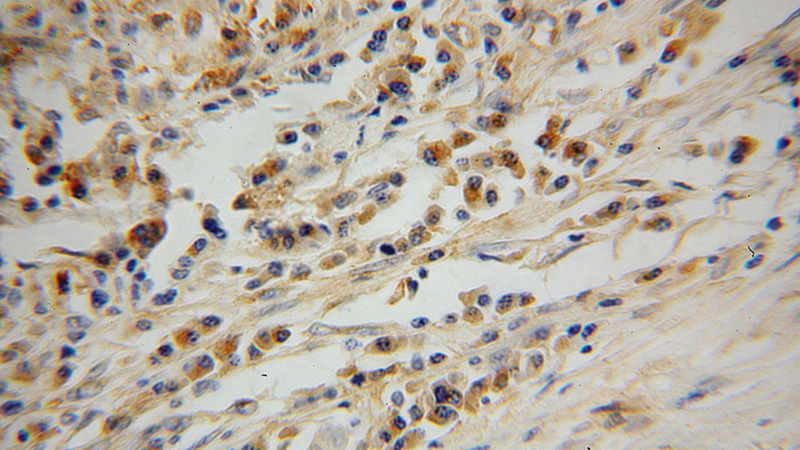 Immunohistochemical of paraffin-embedded human lung cancer using Catalog No:115792(STX12 antibody) at dilution of 1:100 (under 40x lens)