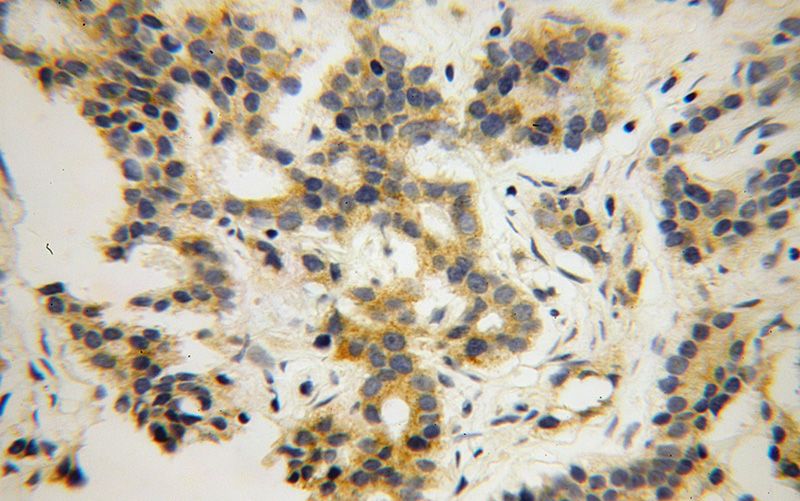 Immunohistochemical of paraffin-embedded human gliomas using Catalog No:114064(SH3RF1 antibody) at dilution of 1:100 (under 40x lens)
