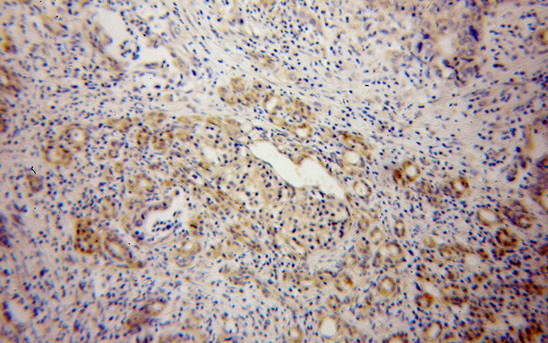 Immunohistochemical of paraffin-embedded human pancreas cancer using Catalog No:110284(ELMOD2 antibody) at dilution of 1:100 (under 10x lens)