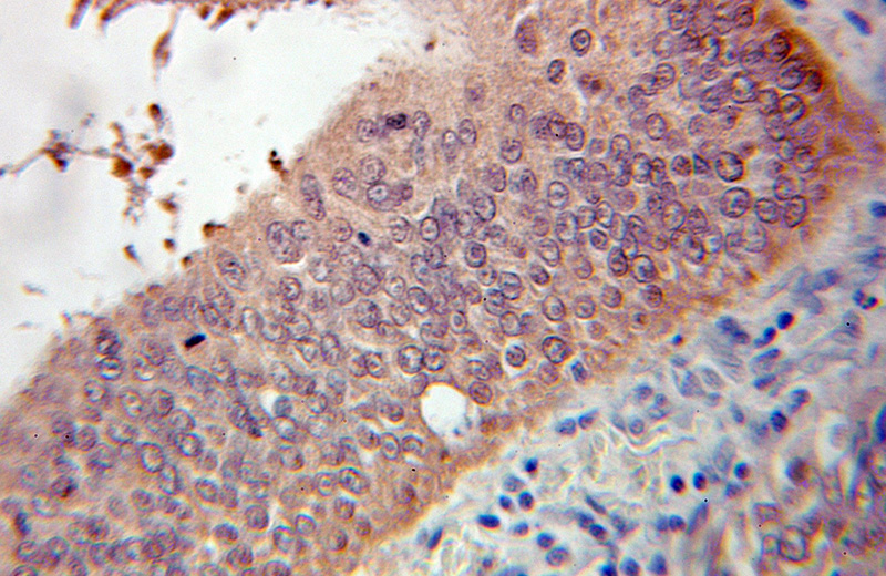 Immunohistochemical of paraffin-embedded human colon cancer using Catalog No:109866(DARPP32 antibody) at dilution of 1:100 (under 10x lens)