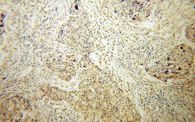 Immunohistochemical of paraffin-embedded human ovary tumor using Catalog No:116493(TULP3 antibody) at dilution of 1:100 (under 10x lens)