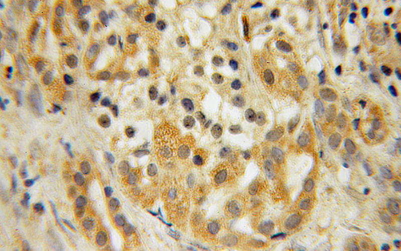 Immunohistochemical of paraffin-embedded human pancreas cancer using Catalog No:112719(MOBKL1A antibody) at dilution of 1:100 (under 10x lens)