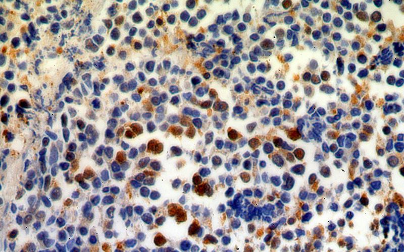 Immunohistochemical of paraffin-embedded human lung cancer using Catalog No:109480(COTL1 antibody) at dilution of 1:50 (under 40x lens)