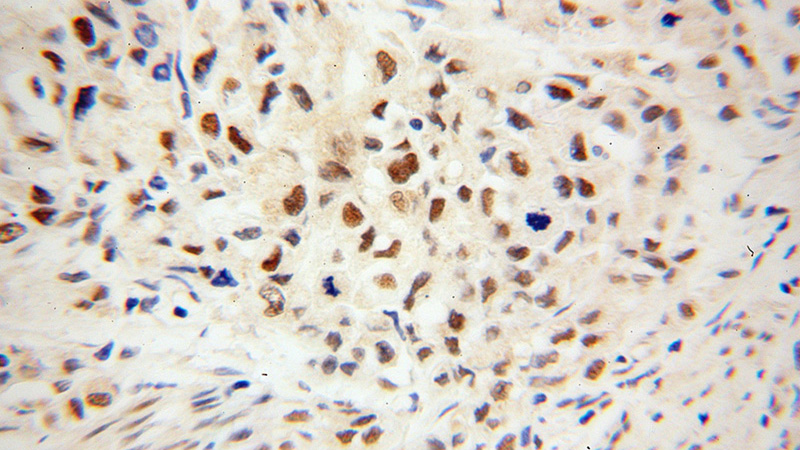 Immunohistochemical of paraffin-embedded human endometrial cancer using Catalog No:111833(IRF2BP1 antibody) at dilution of 1:50 (under 40x lens)