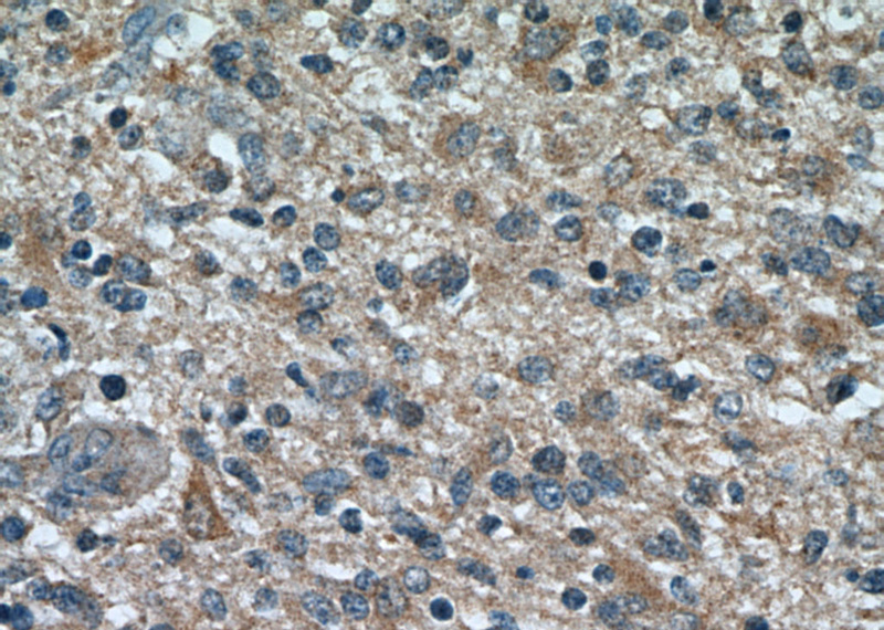 Immunohistochemical of paraffin-embedded human gliomas using Catalog No:116243(TOMM7 antibody) at dilution of 1:50 (under 40x lens)