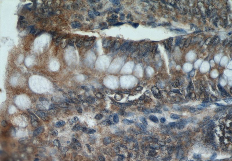 Immunohistochemical of paraffin-embedded human colon using Catalog No:108964(CCDC120 antibody) at dilution of 1:50 (under 40x lens)