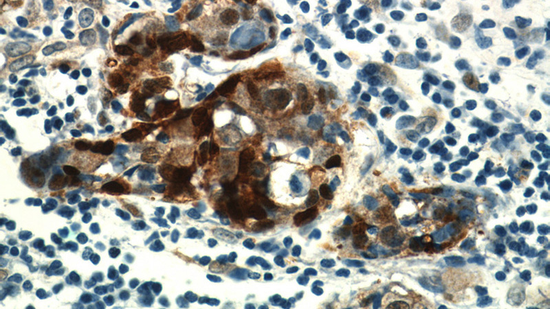 Immunohistochemical of paraffin-embedded human breast cancer using Catalog No:108861(CARM1 antibody) at dilution of 1:50 (under 40x lens)