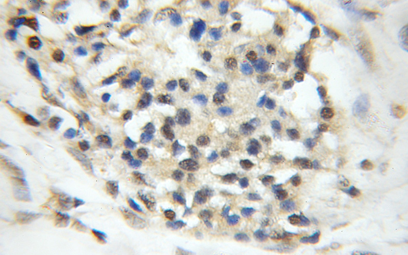 Immunohistochemical of paraffin-embedded human pancreas cancer using Catalog No:113422(ORC5L antibody) at dilution of 1:50 (under 10x lens)