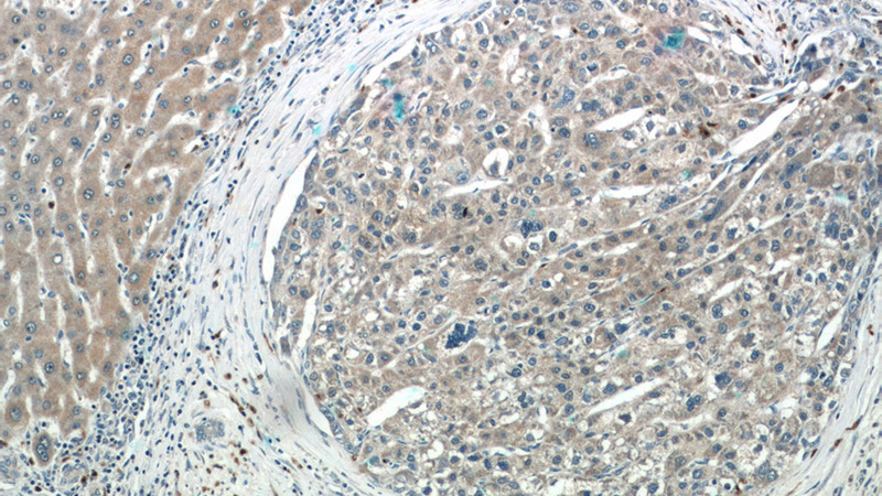 Immunohistochemistry of paraffin-embedded human liver cancer tissue slide using Catalog No:116632(C6orf125 Antibody) at dilution of 1:50 (under 10x lens)