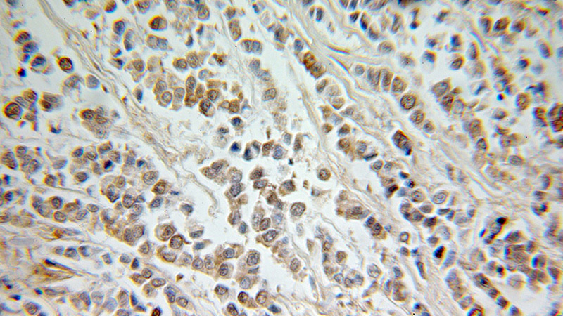 Immunohistochemical of paraffin-embedded human colon cancer using Catalog No:111797(ING5 antibody) at dilution of 1:100 (under 25x lens)