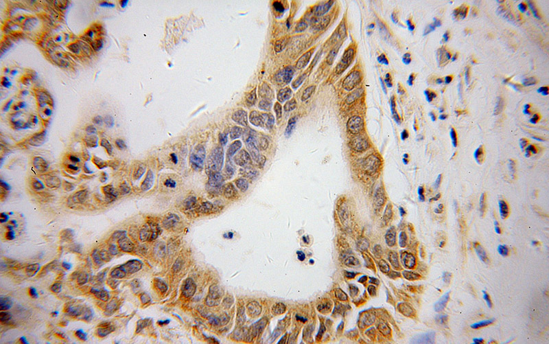 Immunohistochemical of paraffin-embedded human pancreas cancer using Catalog No:107069(ATF4 antibody) at dilution of 1:100 (under 40x lens)