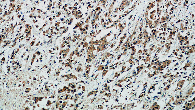 Immunohistochemical of paraffin-embedded human breast cancer using Catalog No:115685(STAT2 antibody) at dilution of 1:50 (under 10x lens)