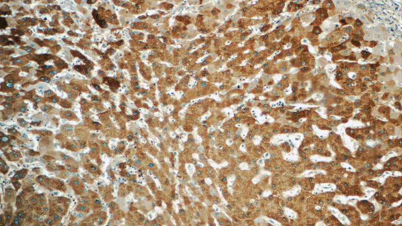 Immunohistochemistry of paraffin-embedded human hepatocirrhosis tissue slide using Catalog No:109903(DGAT1 Antibody) at dilution of 1:50 (under 10x lens)
