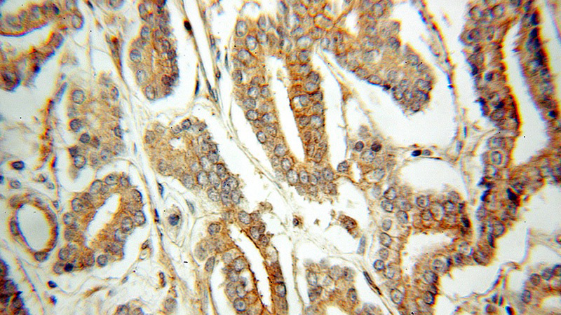 Immunohistochemical of paraffin-embedded human prostate cancer using Catalog No:110485(ETFDH antibody) at dilution of 1:50 (under 40x lens)