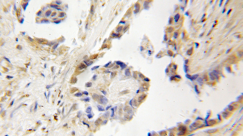 Immunohistochemical of paraffin-embedded human lung cancer using Catalog No:109435(CNOT4 antibody) at dilution of 1:50 (under 10x lens)