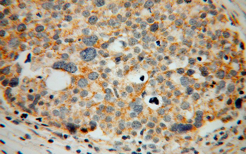 Immunohistochemical of paraffin-embedded human ovary tumor using Catalog No:109476(CORO2B antibody) at dilution of 1:100 (under 40x lens)